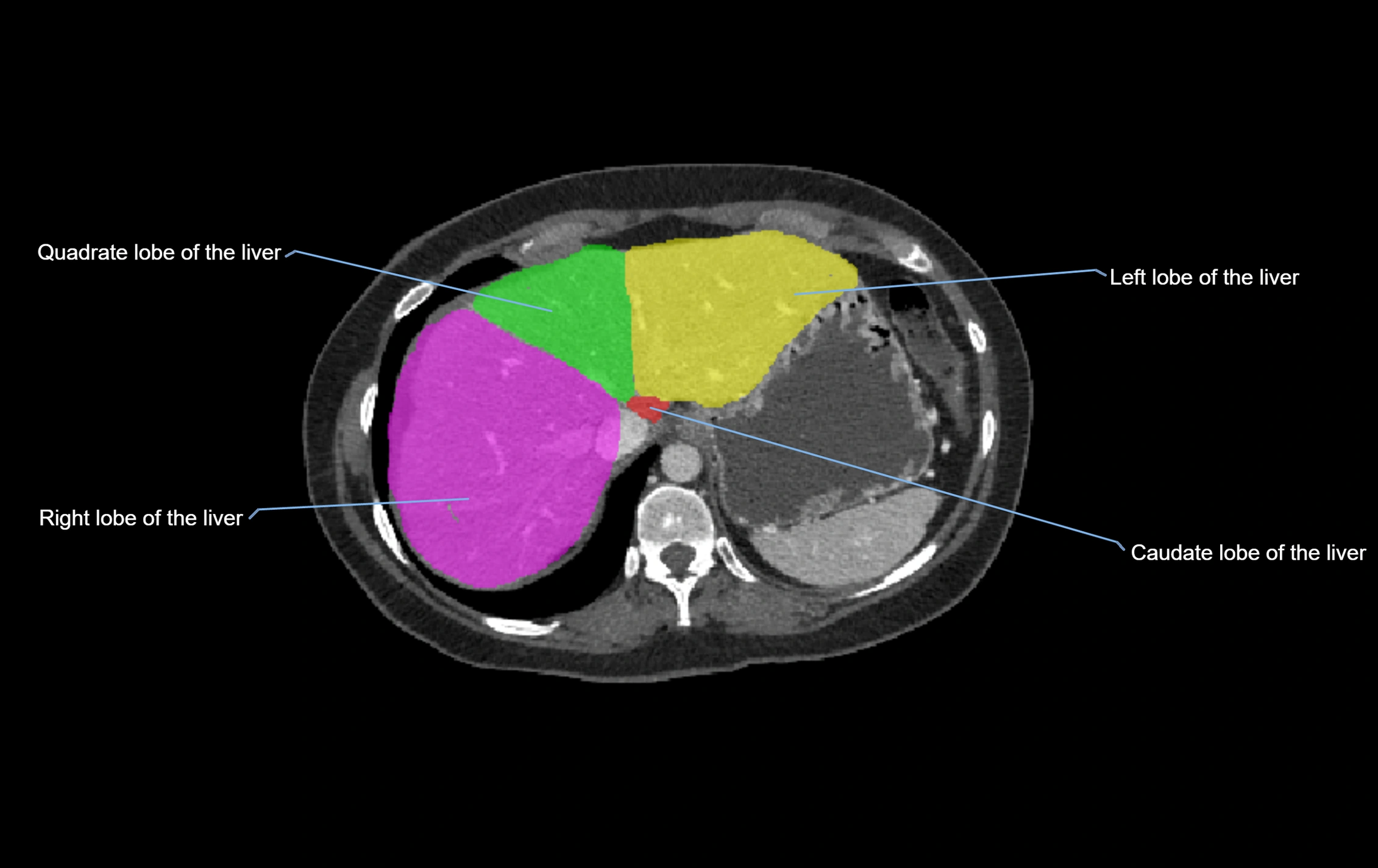 CT lliver lobes axial cross sectional anatomy labelled image -00061.webp